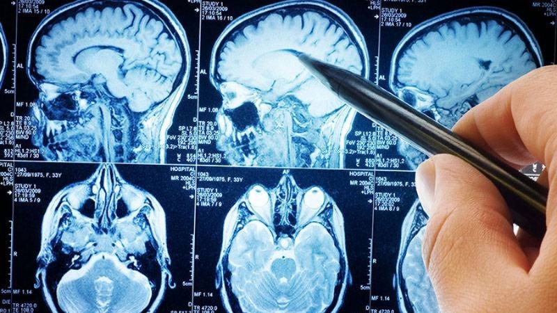 Tumores do cérebro podem surgir em qualquer idade e causaram 930 mortes em Portugal no ano passado